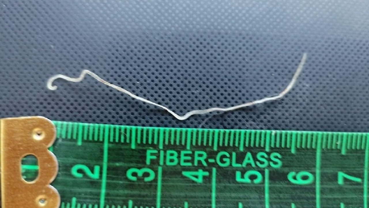 Главная картинка новости: Воронежские хирурги извлекли живого паразита из-под кожи пациентки