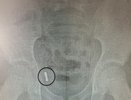 В Воронеже врачи достали из аппендикса ребёнка проглоченные магнитики