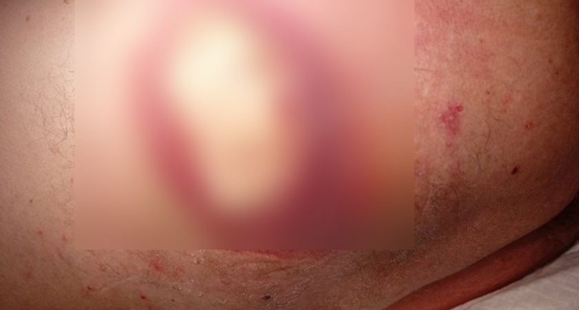 Воронежские врачи провели сложную операцию 68-летнему пациенту с опухолью кожи