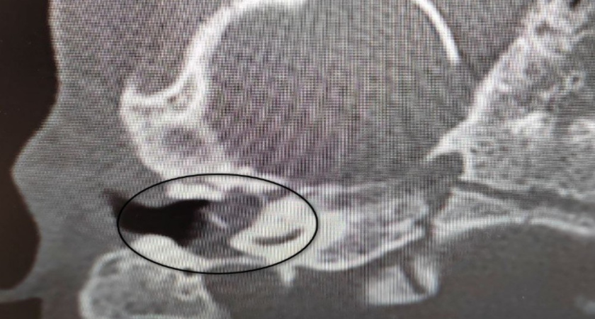 Врачи Воронежской областной детской больницы спасли слух двухлетней девочке