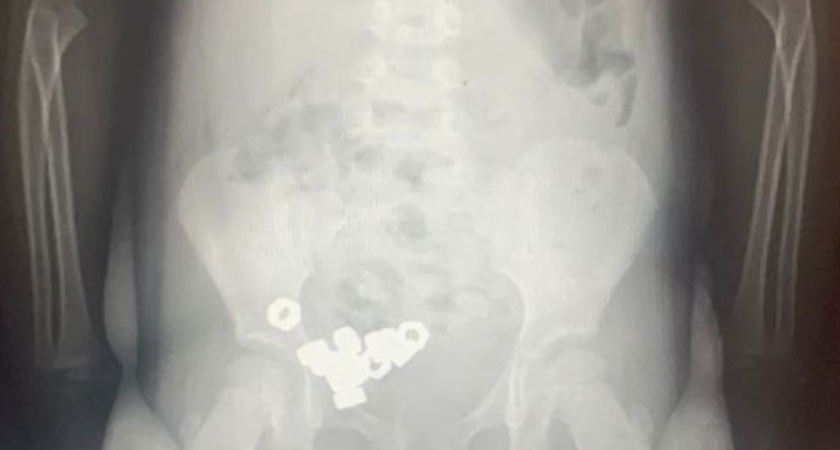 В Воронеже врачи спасли проглотившего 16 металлических гаек трёхлетнего ребёнка