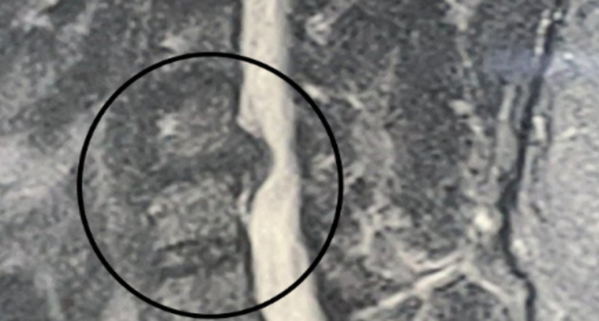 В Воронеже нейрохирурги спасли мужчину от паралича руки