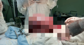 В Воронеже хирурги удалили у 22-летней пациентки огромную опухоль