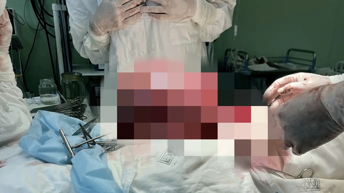 В Воронеже хирурги удалили у 22-летней пациентки огромную опухоль